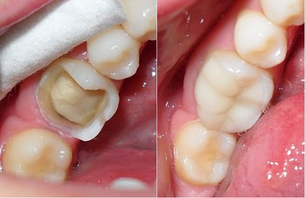 Bị vỡ nửa răng hàm phải làm sao để phục hồi?