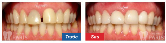 before-after-dental-crowns-03