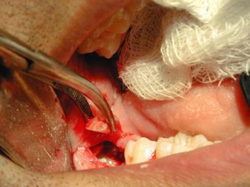 Các biến chứng sau khi nhổ răng khôn bạn cần phải biết