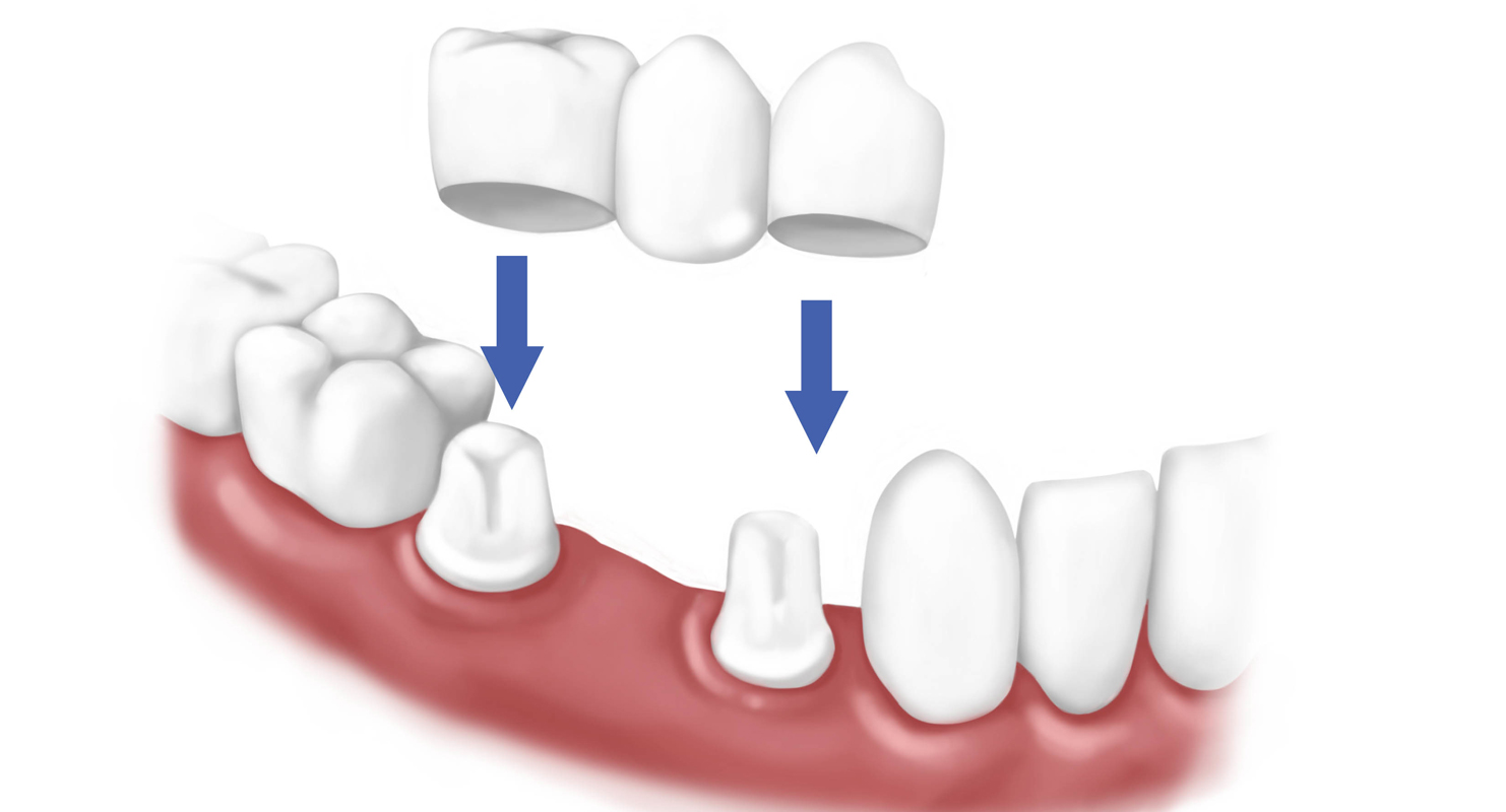 Từ A-Z quy trình làm cầu răng diễn ra như thế nào? 1