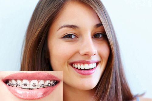 Niềng răng có tốt không hay có hại gì không? 