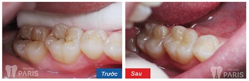 Răng cấm có thay lại không sau khi mọc 1 lần? 3
