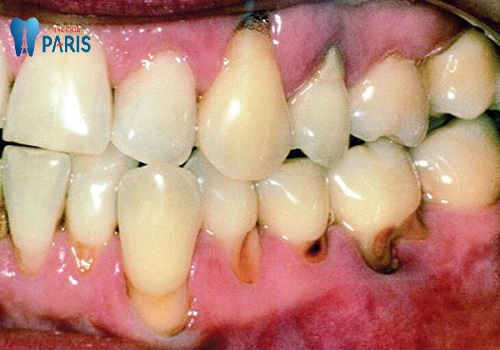 Chân răng bị mục đáng sợ ra sao Cách khắc phục triệt để nhất 1