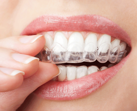 Tổng hợp từ A - Z các vấn đề về bệnh nghiến răng chi tiết nhất 3