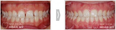 Tổng hợp các vấn đề cần biết về răng thưa 11