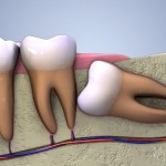 Loay hoay: bị mọc răng khôn phải làm sao để giảm đau nhức ?
