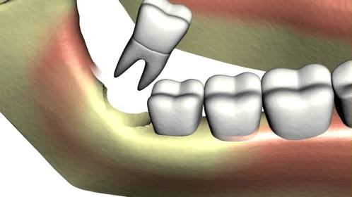 Chuyên gia chia sẻ: Mọc răng khôn uống thuốc gì đảm bảo an toàn giảm đau nhanh?