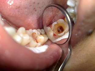 Viêm tủy răng hàm là gì? Có chữa được không?