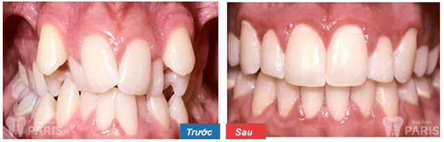 Niềng răng thẩm mỹ 3M UGSL - hiệu quả trọn đời cho hàm răng sai lệch 3