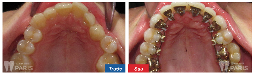 Niềng răng thẩm mỹ 3M UGSL - hiệu quả trọn đời cho hàm răng sai lệch 4