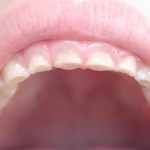 Làm sao chữa bệnh nghiến răng khi ngủ vĩnh viễn?