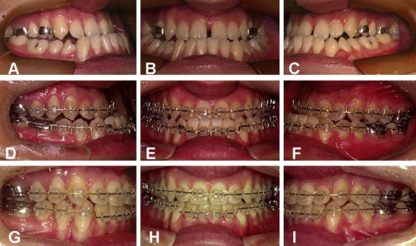 Sai lệch răng móm là gì, có mấy cách chữa trị triệt để? 5
