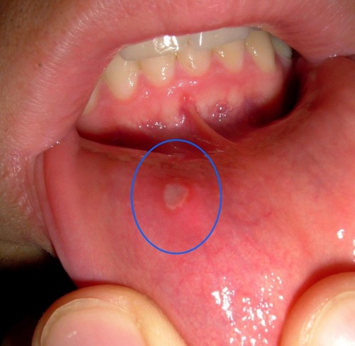 Bệnh lở miệng ở trẻ em – Nguyên nhân & cách chữa trị hiệu quả