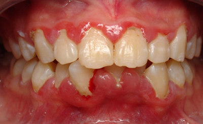 Cách chữa bệnh viêm nướu răng hiệu quả từ Dân gian tới >> Hiện đại 1