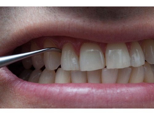 Tổng hợp về cạo vôi răng là gì, thực hiện thế nào?