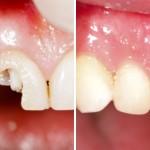 Chữa sứt răng bằng cách nào giúp phục hình hoàn hảo nhất?