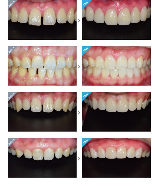 Chữa sứt răng bằng cách nào giúp phục hình hoàn hảo nhất? 3
