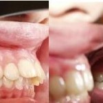 3 cách chữa răng vẩu HIỆU QUẢ hàng đầu hiện nay