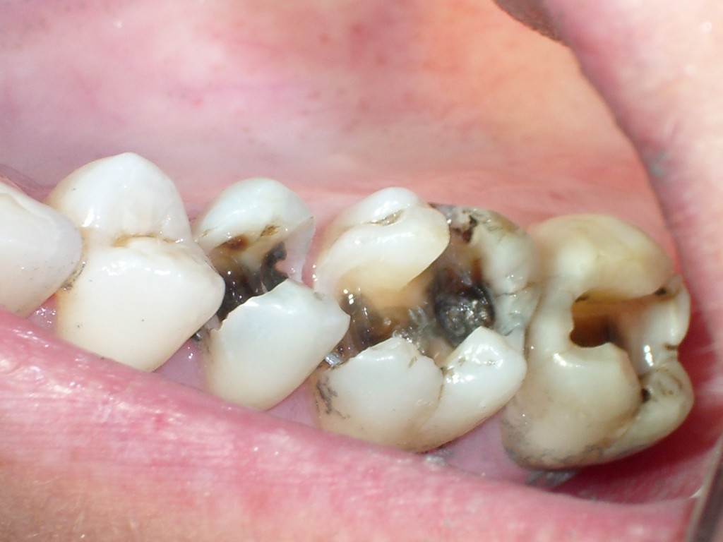 [Làm hết băn khoăn] Răng hàm sâu có nên nhổ không?