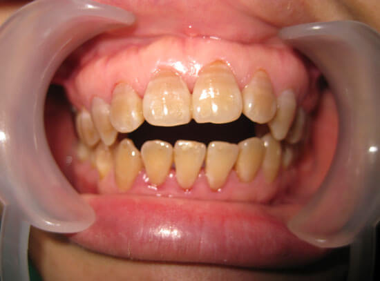 Đánh lún răng là gì? Khi nào thì áp dụng được? 2