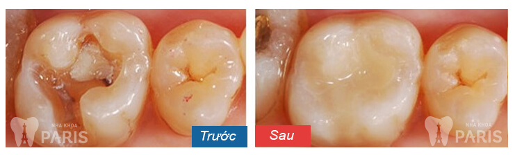 Cách làm trắng răng sâu SIÊU TỐC - An toàn hiệu quả nhất 2