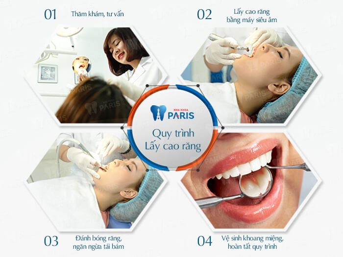 Thời gian lấy cao răng mất bao lâu? Quy trình như thế nào? 4