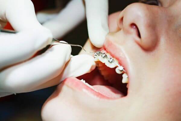 Những thông tin cần thiết về niềng răng móm bạn CẦN PHẢI BIẾT 2