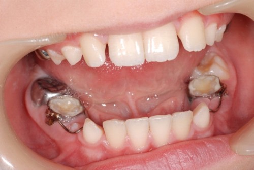 Cách điều trị bệnh viêm tủy răng ở trẻ em hiệu quả 100% 3