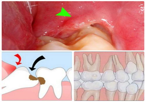 Mọc răng khôn có ý nghĩa gì? Những cách giảm đau CẤP TỐC 3