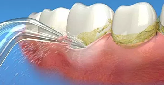 Lấy cao răng bằng máy siêu âm giúp loại bỏ mảng bám, không xâm lấn