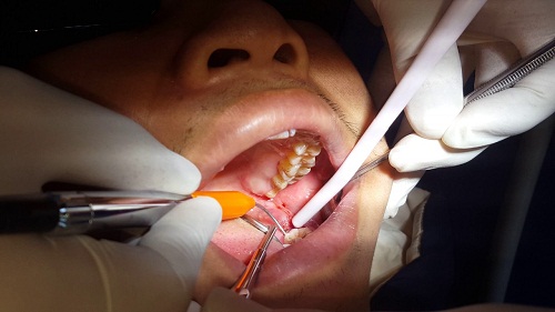 Sưng nướu răng khôn liệu có gây nguy hại cho sức khỏe? Nha khoa Paris 3