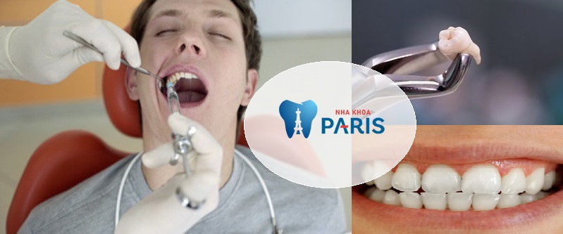 Răng khôn là gì & Nhổ răng khôn có ảnh hưởng gì hay không?