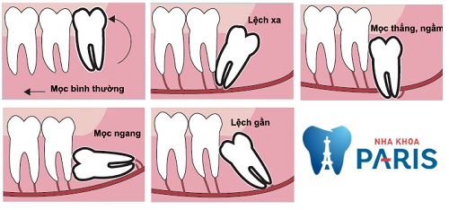 Loay hoay: bị mọc răng khôn phải làm sao để giảm đau nhức ? 