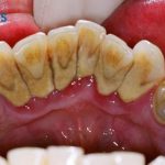 Chân răng bị vàng phải làm sao để làm trắng lại?