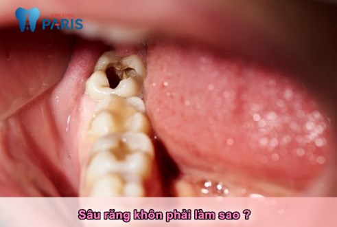 Sổ tay bệnh lý: Sâu răng khôn nên nhổ hay hàn trám ? 1