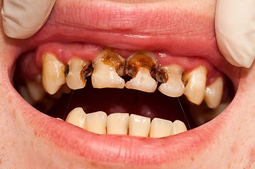 Bị sâu răng phải làm sao? Nguyên nhân