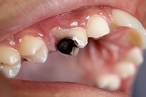 Sâu răng có chữa được không? Chữa trị như thế nào dứt điểm