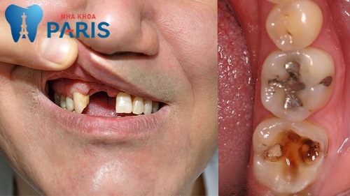 Sâu răng có chữa được không? Điều trị sâu răng như thế nào?
