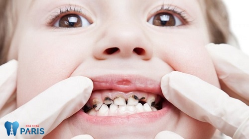 cách chữa sâu răng cho trẻ em